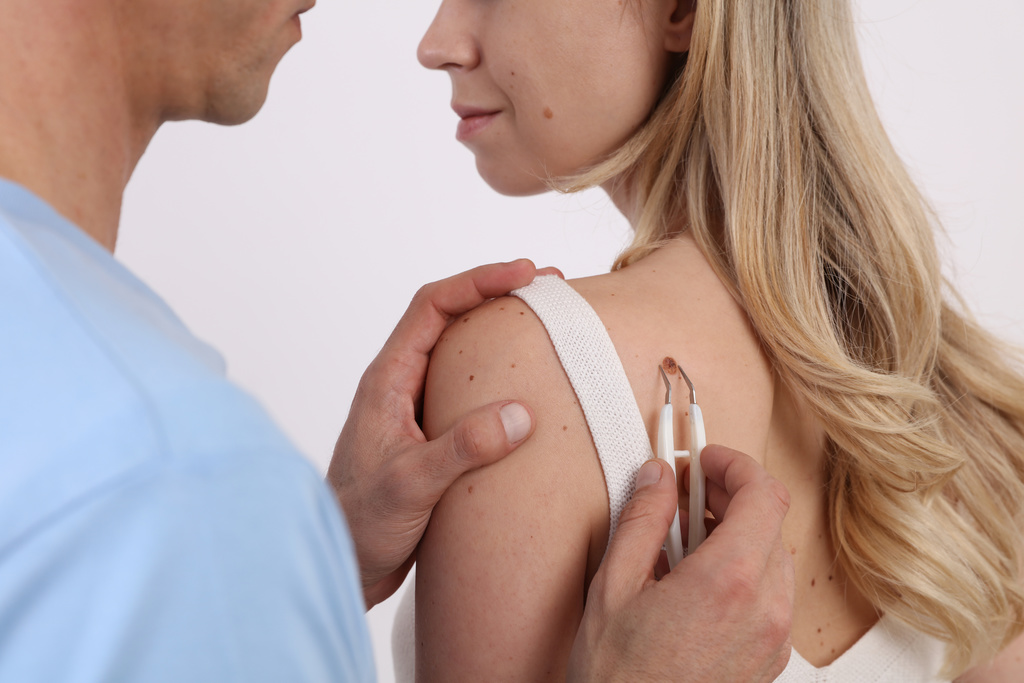 Birthmark , Regular Mole Check. Doctor dermatologist an femele patient. Laser Skin tags removal